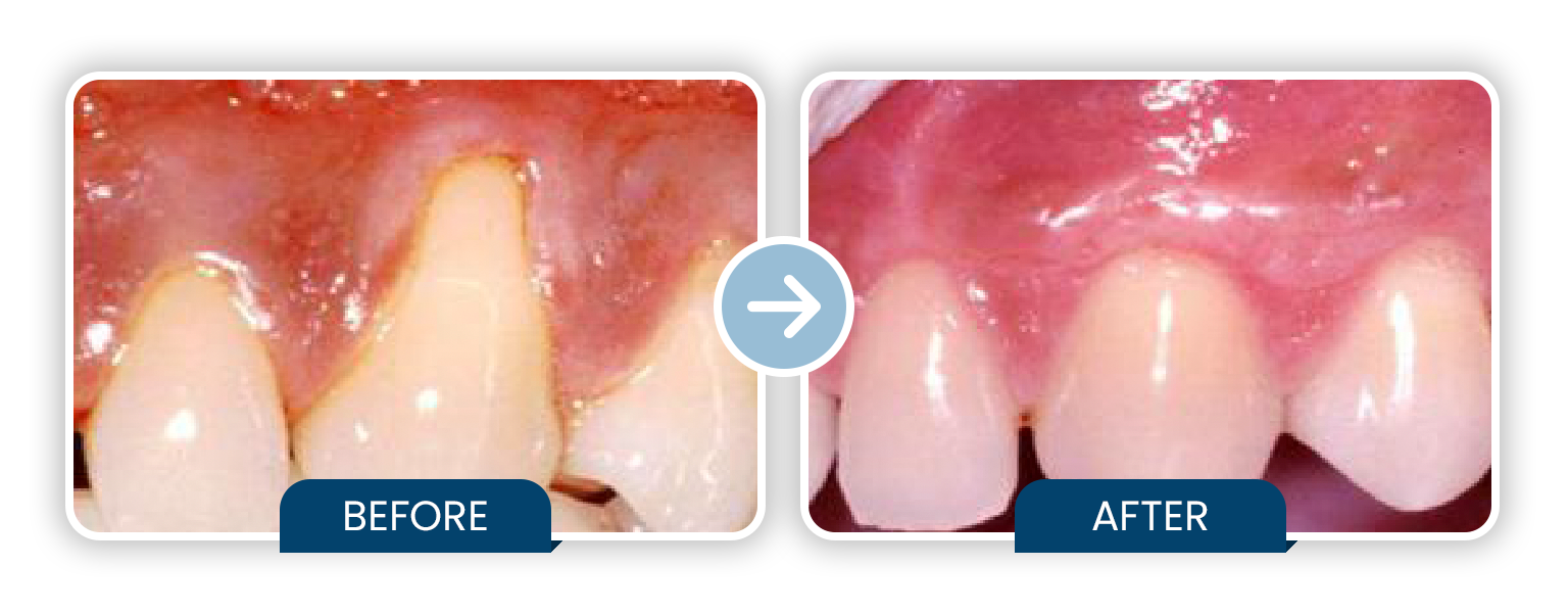 Tissue Graft