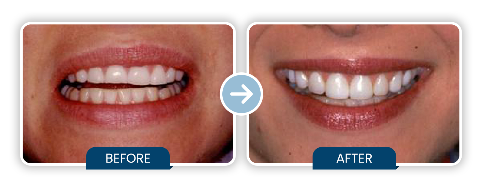 Whitening with Resin Veneers -Bonding