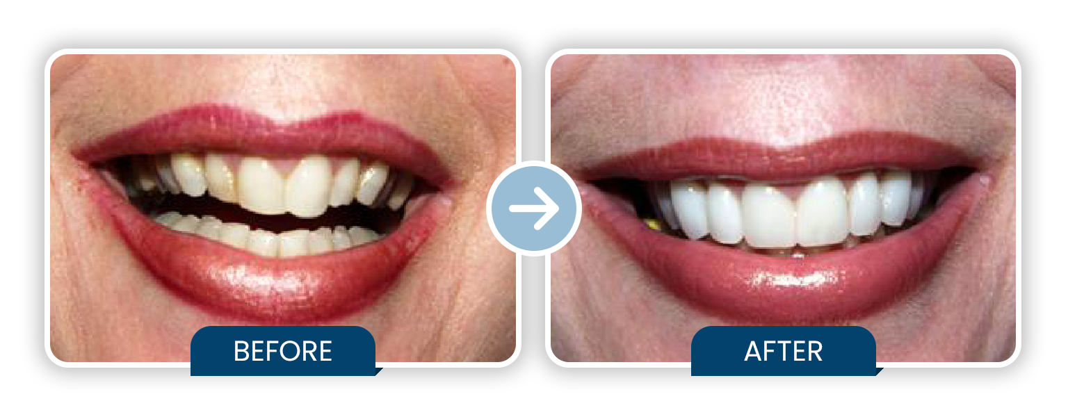 10 Porcelain Veneers