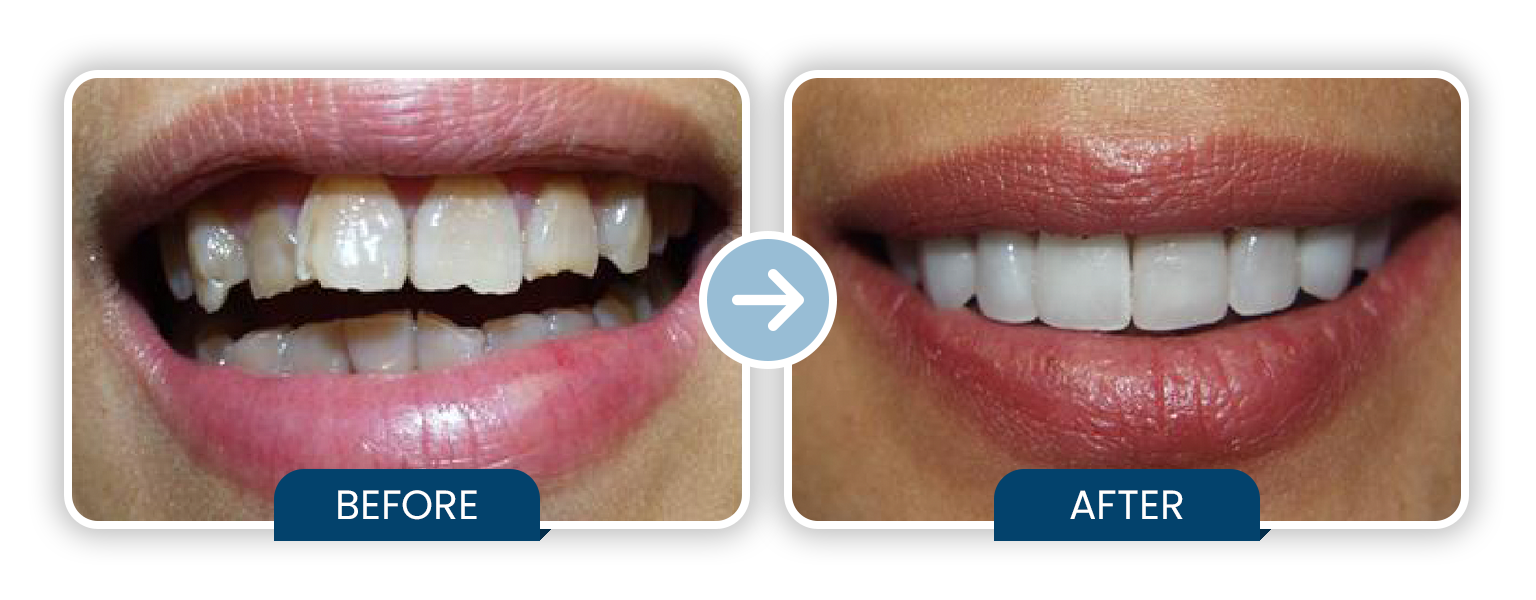 10 Porcelain Veneers