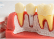 Dental Implants vs Dentures