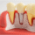 Dental Implants vs Dentures