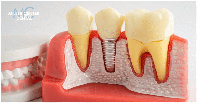 Dental Implants vs Dentures Which Is Better (1) Dental Implants vs Dentures