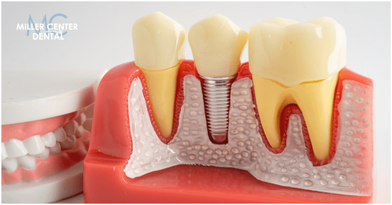 Dental Implants vs Dentures Which Is Better (1) Dental Implants vs Dentures